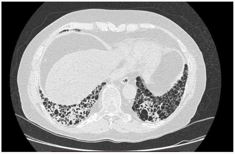 High-resolution computed tomography (HRCT) axial section of the thorax demonstrating a definitive Usual Interstitial Pneumonia (UIP) pattern in a patient with Idiopathic Pulmonary Fibrosis (IPF). The image reveals classic radiologic hallmarks of advanced interstitial lung disease, primarily characterized by extensive honeycombing. These cystic airspaces are predominantly subpleural and basal in distribution, appearing as clustered, thick-walled, lucent cavities of varying sizes. Associated reticular opacities and architectural distortion of the lung parenchyma are evident, indicating chronic fibrotic changes. Traction bronchiectasis may be inferred from the irregular airway dilatation within the fibrotic zones. The mediastinal structures appear grossly normal. This visual presentation is highly characteristic of restrictive lung disease, which clinically correlates with impaired gas exchange and reduced lung compliance.