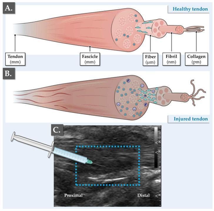 A multi-panel medical graphic illustrating tendon anatomy, pathophysiology, and clinical management. Panel (A) provides an anatomical diagram of a healthy tendon, detailing the hierarchical structure from the whole tendon (mm scale) down to fascicles, fibers (µm), fibrils (nm), and collagen (pm). It shows parallel, organized collagen bundles and sparse, spindle-shaped tenocytes. Panel (B) is a comparison chart showing an injured tendon characterized by disorganization of the extracellular matrix (ECM), collagen denaturing, hypercellularity with rounded cell morphology, and increased presence of immune cells and vascular infiltration. Panel (C) contains a diagnostic ultrasound image of a fissured Achilles tendon in the longitudinal plane. Within a blue dashed box, a linear hypoechoic (dark) area represents the structural fissure, contrasting with the normal hyperechoic fibrillar pattern of a healthy tendon. An overlaid illustration shows a needle delivering a platelet-rich plasma (PRP) injection directly into the fissured site for regenerative therapy. Labels identify proximal and distal orientations, highlighting the clinical application of orthobiologics in managing tendinopathies.