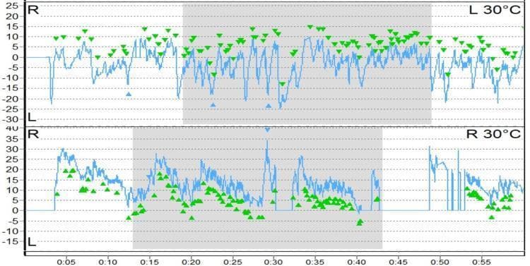 Diagnostic tracing showing Videonystagmography (VNG) results from a caloric reflex test, specifically illustrating the phenomenon of caloric inversion. The image contains two vertically stacked strip charts representing eye movement velocity (slow phase velocity) over time. The top graph is labeled 'L 30°C' (left ear cold irrigation) and the bottom graph 'R 30°C' (right ear cold irrigation). Each graph features a blue continuous line plot representing nystagmus and green arrowheads marking the peak velocity of the slow phase. A grey shaded box highlights the primary response window. Clinically, caloric inversion is characterized by nystagmus beating in a direction opposite to what is expected based on the temperature of the irrigation (COWS: Cold Opposite, Warm Same). In this tracing, the green arrowheads indicate a persistent vestibular response that deviates from standard physiological expectations. This finding is highly significant in neuro-otology as it often suggests central vestibular dysfunction or brainstem pathology, though technical artifacts such as tympanic membrane perforation must be ruled out.