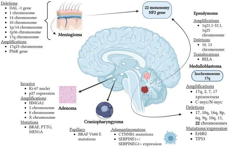An educational pathophysiology diagram illustrating the genetic and chromosomal anomalies associated with specific human brain tumors, set against a sagittal anatomical view of the brain. The diagram categorizes molecular findings for five major tumor types: Meningioma, Adenoma, Craniopharyngioma, Ependymoma, and Medulloblastoma. Key features include: 1) Meningioma: associated with chromosome 22 monosomy, NF2 gene mutation, and various deletions (DAL-1, 1p/14, 1p36). 2) Medulloblastoma: highlights isochromosome 17q, C-myc/N-myc amplifications, and multiple deletions (17, 10q, 16q, 22). 3) Ependymoma: shows 1q25 amplifications and RELA translocations. 4) Adenoma (Pituitary): details Ki-67 nuclei presence, HMGA2 amplification, and BRAF/MEN1A mutations. 5) Craniopharyngioma: distinguishes between Papillary (BRAF V600E) and Adamantinomatous (CTNNB1) mutations. The visual summarizes cytogenetic profiles including monosomies, trisomies, and gene-specific mutations that serve as diagnostic or prognostic markers in neuro-oncology.