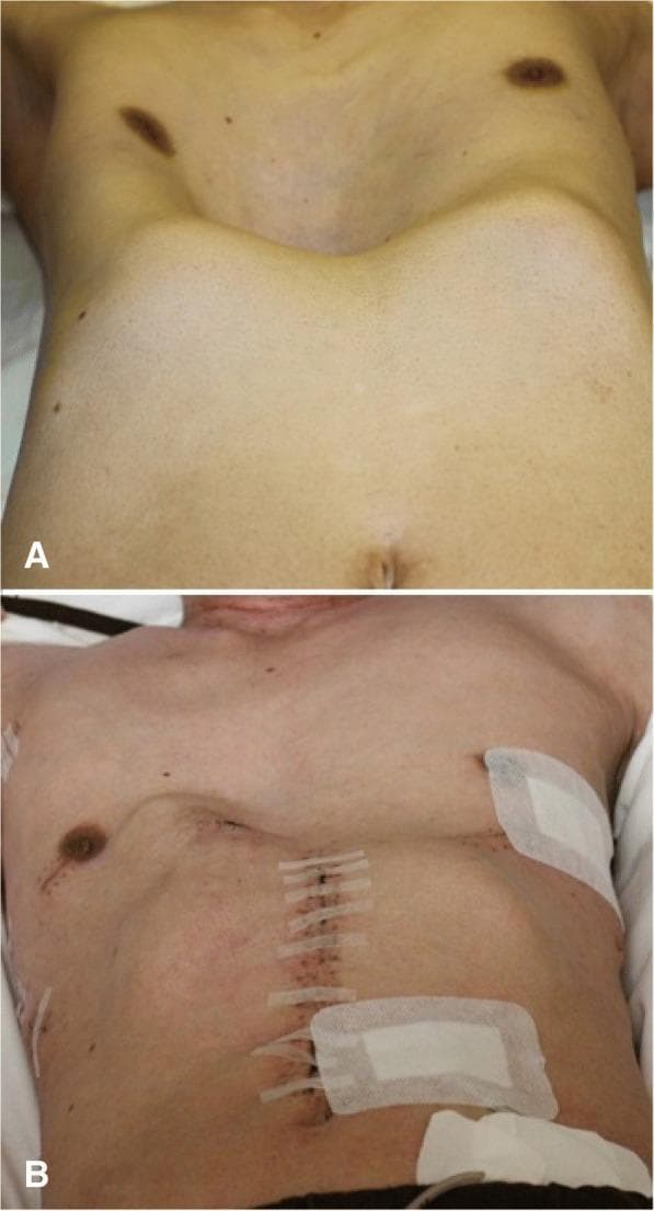 This clinical photograph set presents a pre- and post-operative comparison of a patient with pectus excavatum (funnel chest). Image A depicts the preoperative state, showing a severe congenital chest wall deformity characterized by a deep, central concavity of the sternum. This depression creates a funnel-like appearance with the sternal notch significantly recessed compared to the lateral ribcage and abdominal plane. Image B shows the same patient following surgical correction (Nuss procedure). The chest wall contour is markedly improved, with the sternum repositioned anteriorly to create a more physiological, convex chest profile. Surgical indicators are visible, including a vertical midline incision closed with sutures and adhesive strips (Steristrips), alongside lateral surgical dressings over the thoracic entry points for the metal bars used in the reconstruction. This comparison illustrates the effective anatomical remodeling of the thoracic cavity to increase mediastinal space.