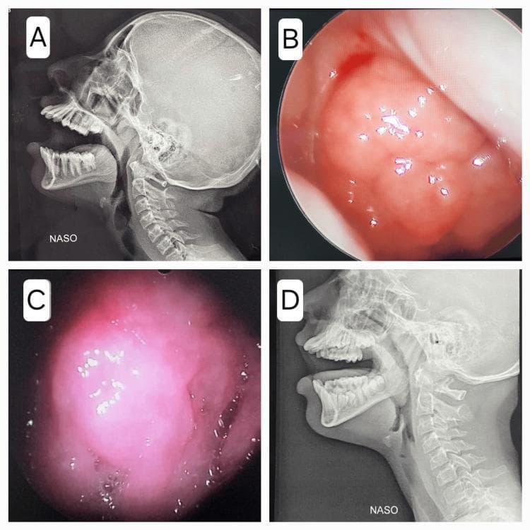 This composite clinical image illustrates the evaluation of adenoid hypertrophy using two different modalities: lateral cephalometric radiography and nasal endoscopy. Panels A and D are lateral X-rays of the skull and cervical spine, specifically labeled 'NASO' to indicate a focus on the nasopharynx. These radiographs demonstrate a soft tissue mass (adenoid) projecting from the posterior nasopharyngeal wall, which narrows the visible air column between the adenoid tissue and the soft palate. Panels B and C are corresponding endoscopic views of the nasopharynx, showing the adenoid tissue as a hyperemic, pinkish-red lobulated mass with a granular, irregular surface. Small white reflective spots across the tissue surface suggest the presence of mucous secretions. This comparison highlights how radiological grading of airway obstruction correlates with direct endoscopic visualization of the lymphoid tissue. These findings are clinically significant in the diagnosis of pediatric obstructive sleep apnea and its associated effects on middle ear pressure and otitis media with effusion.