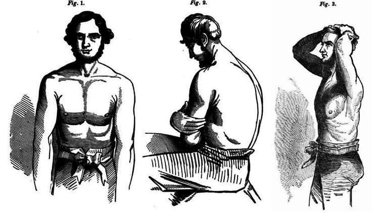 This historical anatomical illustration, sourced from the 1846 treatise 'The Young Stethoscopist' by Henry Ingersoll Bowditch, demonstrates three recommended patient positions for optimal thoracic auscultation. Figure 1 shows a frontal view of a standing patient with the torso exposed, facilitating examination of the anterior chest wall and cardiac landmarks. Figure 2 depicts a seated patient in a lateral profile, arms crossed over the chest and leaning slightly forward; this maneuver protracts the scapulae, providing unobstructed access to the posterior lung fields and interscapular regions. Figure 3 illustrates a standing profile with both hands clasped behind the head, a position that elevates the rib cage and exposes the lateral thoracic and axillary regions for comprehensive pulmonary assessment. These illustrations serve as an early educational guide for medical students to master physical examination techniques, emphasizing the importance of patient positioning in detecting respiratory murmurs and adventitious lung sounds. The content represents a significant development in clinical semiology and the history of diagnostic medicine.