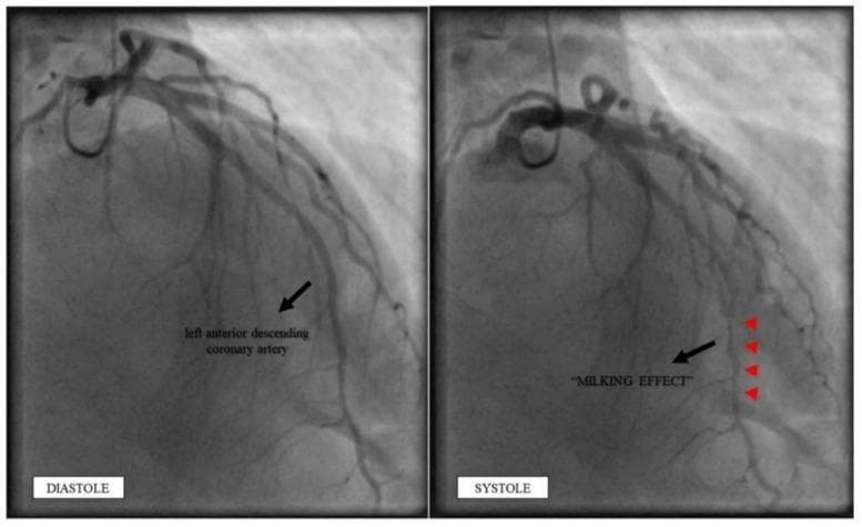 This diagnostic image displays a side-by-side comparison of invasive coronary angiography frames in a patient with myocardial bridging. The panels represent the cardiac cycle phases: 'DIASTOLE' (left) and 'SYSTOLE' (right). The focus is on the Left Anterior Descending (LAD) coronary artery. In the diastole phase, the LAD demonstrates a normal, uniform caliber. In the systole phase, the mid-portion of the LAD shows a significant, focal reduction in vessel diameter, indicated by red arrowheads. This characteristic visual finding is known as the 'milking effect,' where the overlying myocardial muscle bridge compresses the coronary artery during ventricular contraction. This dynamic stenosis is a hallmark diagnostic feature of myocardial bridging, differentiating it from fixed atherosclerotic lesions. The images are essential for demonstrating the pathophysiology of exercise-induced ischemia or angina in patients with anomalous intramyocardial arterial courses.