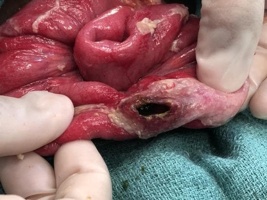 This clinical photograph is an intra-operative view depicting a typhoid intestinal perforation in the terminal ileum. The image shows a segment of small bowel held by gloved hands against a sterile surgical drape. A single, well-defined oval-shaped perforation is visible on the antimesenteric border, oriented along the longitudinal axis of the bowel. The perforation site displays dark, necrotic edges and is surrounded by an area of blanched, pale, and thickened tissue, indicating localized ischemia and inflammatory exudate. The adjacent intestinal wall appears erythematous and edematous, consistent with generalized peritonitis or severe enteritis. Small yellowish inflammatory plaques are visible on the serosal surface. This lesion is a pathognomonic finding of Typhoid Intestinal Perforation (TIP), resulting from the necrosis of Peyer's patches. It is a critical educational resource for understanding the surgical complications of Salmonella typhi infection in general surgery and infectious disease specialties.