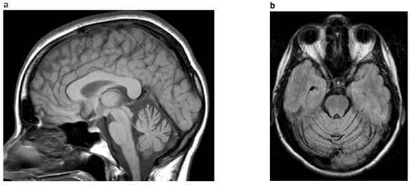 Diagnostic neuroimaging (MRI) of the brain in T1-weighted sequences, presenting a sagittal view (A) and an axial view (B). The images demonstrate significant olivopontocerebellar atrophy in a patient with Spinocerebellar Ataxia Type 2 (SCA2). In the sagittal view, there is marked volume loss of the cerebellum and the brainstem (specifically the pons and medulla), characterized by prominent cerebellar fissures and a diminished pontine belly. The axial view confirms these findings, showing disproportionate cerebellar atrophy relative to the cerebral hemispheres, with widening of the cerebellar sulci and thinning of the folia. These radiological features are consistent with the clinical presentation of progressive ataxia, dysarthria, and slowed saccadic eye movements. The images serve as an educational example of neurodegeneration in Autosomal Dominant Cerebellar Ataxia (ADCA), highlighting the anatomical distribution of tissue loss in the posterior fossa.