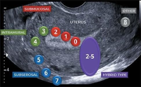 This diagnostic ultrasound image demonstrates the FIGO (International Federation of Gynecology and Obstetrics) classification system for uterine fibroids (leiomyomas). The image shows a grayscale sagittal view of a uterus with heterogeneous, hypoechoic texture. Numbered circular overlays are used to map fibroid locations relative to the uterine wall layers. Red markers 0, 1, and 2 identify 'Submucosal' fibroids (ranging from pedunculated intracavitary to ≥ 50% intramural). Green markers 3 and 4 identify 'Intramural' fibroids. Blue markers 5, 6, and 7 represent 'Subserosal' positions (ranging from ≥ 50% intramural to pedunculated subserosal). A large purple oval labeled '2-5' indicates the 'Hybrid Type' (contacting both the endometrium and serosa, but < 50% of each), and a gray marker '8' indicates 'Other' locations such as cervical or parasitic fibroids. This anatomical diagram serves as an educational guide for clinicians to determine surgical approaches, such as hysteroscopic versus laparoscopic myomectomy, based on lesion classification.