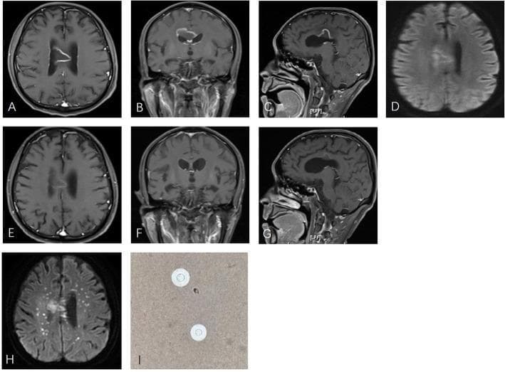 This composite figure illustrates the radiological and microbiological findings of a cerebral cryptococcal infection. Panels A-C show axial, coronal, and sagittal postcontrast T1-weighted MR images revealing a large, centrally located mass in the corpus callosum exhibiting prominent rim enhancement and surrounding vasogenic edema. Panel D is an initial diffusion-weighted image (DWI) showing rim hyperintensity without internal restricted diffusion, a finding that can distinguish this from a typical pyogenic brain abscess. Panels E-G demonstrate significant lesion regression and reduced enhancement 42 days after corticosteroid therapy, illustrating the potentially misleading radiological response of infectious pseudotumors to anti-inflammatory treatment. Panel H shows a subsequent DWI (70 days post-initial imaging) revealing new, multiple punctate hyperintense foci in the centrum semiovale, indicating disease progression and dissemination. Panel I is a cerebrospinal fluid (CSF) microscopy image using India ink stain, identifying the presence of encapsulated Cryptococcus neoformans yeast cells characterized by clear halos against the dark background. This sequence highlights the diagnostic challenge of differentiating fungal masses from neoplastic or demyelinating lesions.