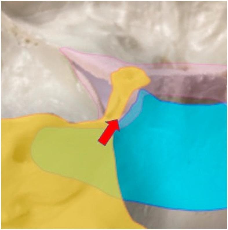 Anatomical Diagram and intraoperative overlay illustrating the arterial blood supply to the cavernous sinus, specifically regarding the feeding vessels of skull base meningiomas. The cavernous sinus is highlighted by a pink outline. The arterial distribution is color-coded: the Tentorial Artery (TA) is represented in yellow, demonstrating its supply to the superolateral aspect of the posterior cavernous sinus. The Dural Meningeal Artery (DMA) is shown in blue, highlighting its coverage of the inferomedial portion of the posterior cavernous sinus. A red arrow identifies the interface where cranial nerves are typically situated between these two arterial territories. The image serves as a clinical reference for neurosurgical planning, helping to differentiate between petrotentorial and petroclival meningioma attachments based on their primary feeding arteries and their spatial relationship to critical neurovascular structures within the skull base.