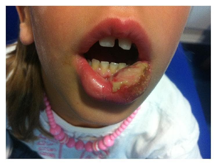 A clinical photograph of a pediatric patient's face, focusing on a self-inflicted traumatic injury to the lower lip. The left side of the lower lip exhibits a large, irregular traumatic ulcer characterized by a central yellowish-white fibrinous slough and a granular texture, indicative of soft tissue necrosis or deep ulceration. The surrounding labial mucosa and vermilion border are erythematous and edematous. Visible within the oral cavity are primary teeth with mild plaque accumulation and gingival inflammation adjacent to the injury site. The photograph demonstrates a classic presentation of post-anesthetic lip biting, a common complication in pediatric dentistry following mandibular nerve blocks or long-acting local anesthesia where numbness leads to inadvertent masticatory trauma. This image serves as an educational tool for identifying traumatic oral ulcers and emphasizes the importance of postoperative caregiver education regarding numbing effects in children.