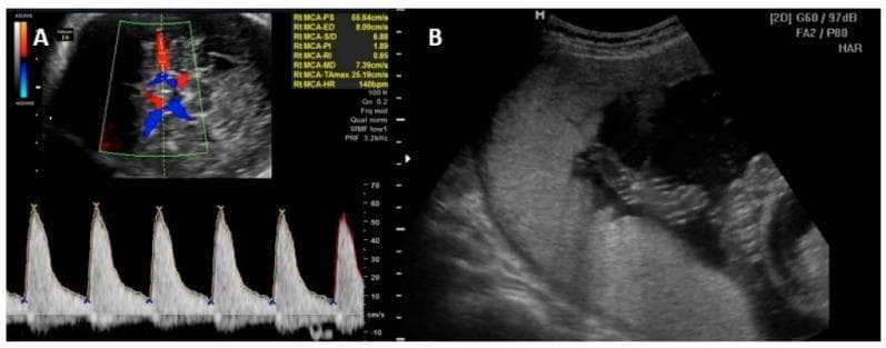This composite diagnostic image demonstrates key ultrasonographic procedures used in the management of fetal anemia, frequently associated with intrauterine parvovirus B19 infection. Panel A illustrates the measurement of the Middle Cerebral Artery (MCA) Peak Systolic Velocity (PSV) using color and spectral Doppler. The top portion shows a transverse view of the fetal head with color flow mapping identifying the Circle of Willis, while the bottom portion displays a high-resistance pulsatile spectral waveform. Quantitative data indicates a peak systolic velocity (PSV) of 55.84 cm/s and a heart rate of 140 bpm, metrics critical for non-invasive screening of fetal anemia. Panel B presents a grayscale B-mode ultrasound image of an intrauterine transfusion (IUT). A hyperechoic needle is visualized being guided into the umbilical vein at the placental insertion site. The image shows the relationship between the placental mass, the anechoic amniotic fluid, and the needle trajectory. These panels represent standard maternal-fetal medicine protocols for diagnosing and treating severe fetal alloimmunization or viral-induced hematopoietic suppression.