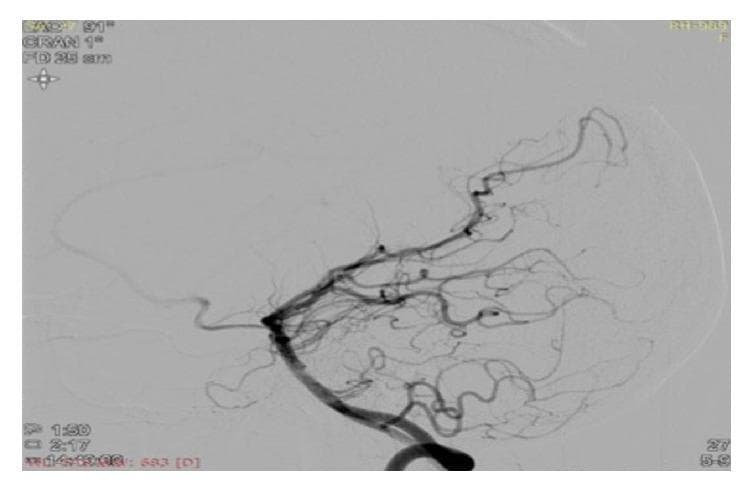 This diagnostic image is a cerebral angiogram (digital subtraction angiography) illustrating significant neurovascular pathology in an 18-year-old patient. The image shows the right internal carotid artery and middle cerebral artery (MCA) territory. There is a near-total to complete occlusion of the right M1 segment of the MCA, occurring just distal to its origin. Characteristic of Moyamoya disease or syndrome, a dense, hazy network of fine, thread-like collateral vessels—known as 'puff of smoke' or Moyamoya collaterals—is visible, attempting to reform the distal M1 segment through small perforating arteries. Comparison reveals a reduced caliber of the right internal carotid artery relative to the contralateral side, suggesting proximal stenosis. The peripheral vasculature appears as a complex, delicate web of compensatory vessels. This finding is clinically significant for explaining ischemic events and stroke in young patients, particularly in the context of hyperhomocysteinemia or idiopathic Moyamoya. The image serves as a classic educational example of intracranial arterial stenosis with resultant secondary collateralization.