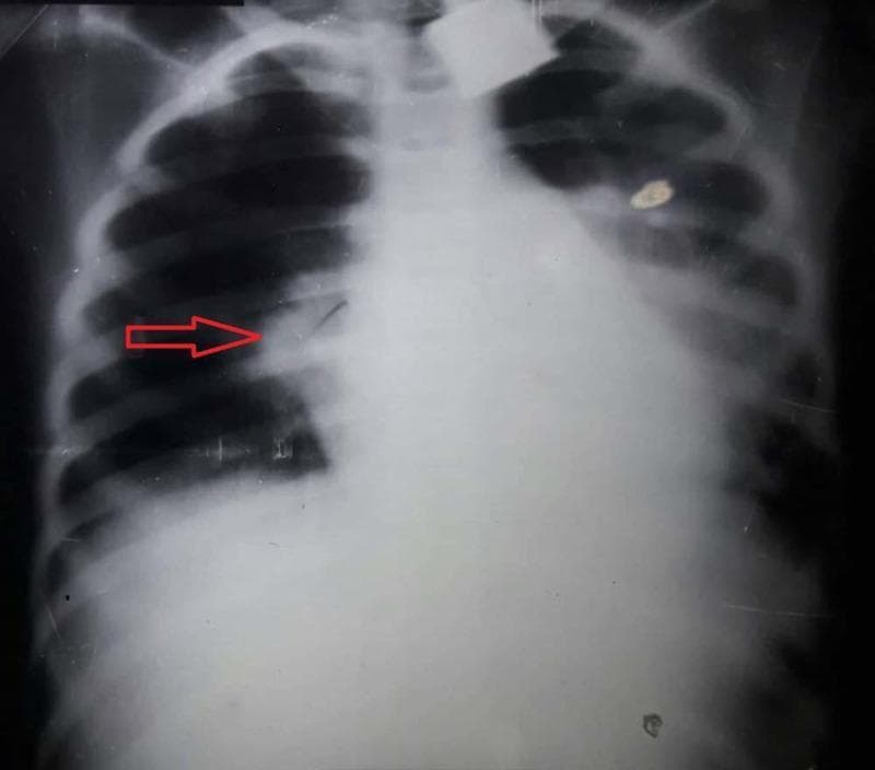 This diagnostic image is an anteroposterior (AP) chest X-ray of a pediatric patient demonstrating classic findings of lobar pneumonia. A prominent, dense, and homogenous opacification is localized to the right upper lobe, consistent with pulmonary consolidation. The opacification has a well-defined inferior border along the horizontal fissure, indicated by a red arrow, which is a hallmark of lobar involvement. Normal lung markings in this region are obscured, while the left lung field appears relatively clear and well-aerated. The cardiac silhouette and mediastinal structures appear within normal limits for this projection, with no significant shift or widening. The diaphragm and costophrenic angles are visible, though the right side is partially obscured by the adjacent consolidation. This image serves as an educational example of bacterial pneumonia presentation in a clinical setting, highlighting the radiographic appearance of alveolar space filling.
