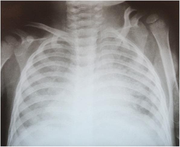 Anteroposterior (AP) pediatric chest X-ray taken following extubation, demonstrating significant bilateral lung pathology. The image reveals diffuse, bilateral interstitial and alveolar infiltrates across all lung zones, consistent with a primary pulmonary process such as acute respiratory distress syndrome (ARDS) or extensive pneumonia. Despite the diffuse opacities, there are no classic radiological signs of cardiogenic pulmonary edema, such as cardiomegaly or prominent cephalization of pulmonary vessels. The trachea is centrally positioned and patent. Visible skeletal structures include the clavicles, ribs, and scapulae, which appear intact and age-appropriate. This diagnostic image illustrates the clinical progression of severe pulmonary infection, specifically tuberculosis-related ARDS, highlighting the persistent radiological findings even as clinical oxygenation parameters (P/F ratio) improve. The radiograph serves as an educational example of managing complex pediatric respiratory failure in an intensive care setting.