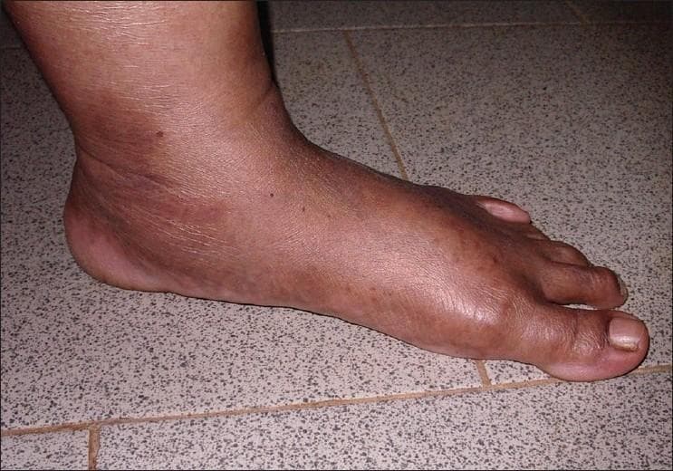 This clinical photograph displays a lateral view of a human foot resting on a tiled surface, demonstrating a complete collapse of the medial longitudinal arch, a condition known as pes planus (flat foot). The plantar surface of the midfoot is in direct contact with the ground. The skin over the foot and ankle appears thin with subtle horizontal wrinkling and mild hyperpigmentation, particularly around the malleolar region. There are no overt primary skin lesions, though the appearance is consistent with the soft, translucent skin often observed in connective tissue disorders such as Ehlers-Danlos Syndrome (EDS). The anatomical focus is on the orthopedic deformity of the foot and the qualitative texture of the skin, which serves as a diagnostic sign for systemic hypermobility syndromes.