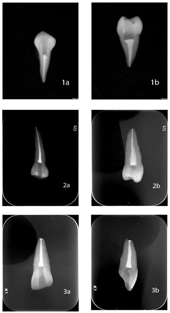 This diagnostic radiographic image displays six dental X-rays organized in a 3x2 grid, illustrating the outcomes of three endodontic obturation techniques. Each technique is shown in two views: vestibule-lingual (left column) and mesiodistal (right column). Panels 1a and 1b demonstrate Cold Lateral Condensation, showing variable density and slight irregularities in the radiopacity of the root canal filling. Panels 2a and 2b depict the Continuous Wave technique, characterized by a highly homogenous and dense radiopaque filling with superior adaptation to the canal walls. Panels 3a and 3b illustrate a Hybrid Technique, showing balanced filling density and apical seal. The image serves as a comparative study in restorative dentistry, focusing on the homogeneity, apical extent, and wall adaptation of gutta-percha and sealer within the root canal system. Key educational concepts include endodontic compaction efficacy, radiographic evaluation of obturation quality, and anatomical adaptation of dental filling materials.