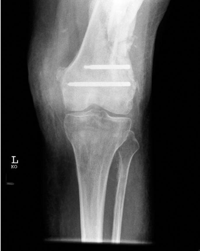 This diagnostic X-ray (radiograph) shows an anteroposterior (AP) view of a left knee joint, focusing on the distal femur, proximal tibia, and fibula. The image highlights a complication of orthopedic hardware removal. Two radiopaque, metallic locking screws are visible embedded transversely within the distal femoral metaphysis, superior to the joint line. Notably, the screw heads are absent, appearing blunt and flush with the lateral cortex of the femur. These represent retained hardware fragments after the screw heads were destroyed during a difficult extraction procedure, typically necessitated by issues such as cold welding or stripping of the Less Invasive Stabilisation System (LISS) plate. The surrounding bone shows evidence of prior surgical intervention and remodeling. This image is an educational example of orthopedic surgical complications, specifically the management of damaged locking compression plate (LCP) components during implant removal.