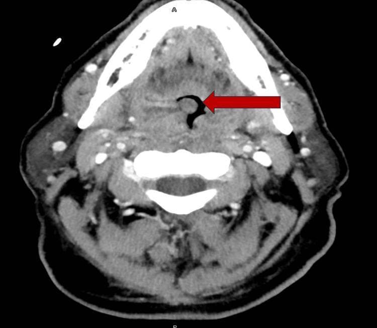 This diagnostic image is an axial computed tomography (CT) scan of the neck with intravenous contrast. The primary finding is significant bilateral palatine tonsillar enlargement (tonsillar hypertrophy). The enlarged tonsillar tissue is characterized by heterogeneous attenuation, with distinct internal hypoattenuating areas (measuring approximately 0.5 cm) suggestive of small intratonsillar abscesses or microabscesses. A large red arrow points to the resulting severe narrowing of the oropharyngeal airway, which is significantly compromised by the mass effect of the inflamed tonsils. Surrounding soft tissue structures demonstrate inflammatory changes consistent with infectious tonsillitis or pharyngitis. This imaging modality is used in Otolaryngology to differentiate between uncomplicated cellulitis and abscess formation requiring surgical drainage, and to assess for airway obstruction in severe upper respiratory infections.