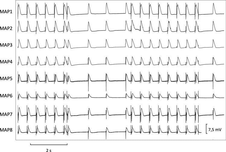 This diagnostic trace image displays eight simultaneous monophasic action potential (MAP) recordings, labeled MAP1 through MAP8, used in cardiac electrophysiology research. The primary focus is the determination of effective refractory periods (ERP) at a basic cycle length of 500 ms. The traces exhibit characteristic cardiac action potential morphology with rapid depolarization and subsequent repolarization phases. Throughout the 2-second time interval (indicated by the scale bar), regular pacing stimuli are followed by short-coupled extrastimuli (S2/S3) to test ventricular vulnerability and refractory periods. Variations in amplitude and morphology are visible across the different MAP traces, with a voltage scale of 7.5 mV provided for reference. Notable features include the presence of premature beats and varying repolarization kinetics (APD90/APD50) across different anatomical recording sites. This recording is representative of programmed electrical stimulation protocols used to assess spatial dispersion of repolarization and the propensity for arrhythmias such as ventricular tachycardia or torsade de pointes.