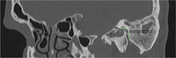 This diagnostic image is a sagittal reformatted Multidetector Computed Tomography (MDCT) scan of the human temporal bone and midface region. The anatomical focus is the course of the facial nerve canal within the temporal bone. Key visible structures include the mastoid air cells with their characteristic trabecular pattern, the middle ear cavity, and the paranasal sinuses anteriorly. The image features a quantitative assessment where two green linear annotations are superimposed to track the facial nerve's trajectory. One line follows the horizontal tympanic segment, while the second line follows the vertical mastoid segment. These lines intersect at the second genu of the facial canal, and a digital measurement box displays the resulting angle (107.7 degrees). This radiographic technique is used in otolaryngology and radiology for preoperative surgical planning and anatomical variation assessment, particularly to identify the precise angulation of the facial nerve to avoid iatrogenic injury during mastoidectomy or middle ear surgery.