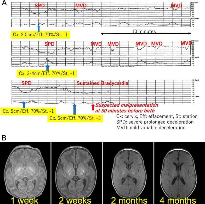 This composite educational graphic details fetal distress and its neurological sequelae. Panel A presents a sequential cardiotocography (CTG) strip documenting the final hour of labor. The upper trace shows fetal heart rate (FHR) displaying mild variable decelerations (MVD) and severe prolonged decelerations (SPD). The lower trace monitors uterine contractions. Integrated clinical data markers correlate heart rate patterns with cervical dilation (2cm to 5cm), 70% effacement, and fetal station changes (moving from -1 to a floating -3 station). The final strip demonstrates sustained terminal bradycardia, marked as 'suspected malpresentation.' Panel B displays four sequential axial brain MRI slices of the infant from 1 week to 4 months of age. These images track the evolution of hypoxic-ischemic encephalopathy (HIE), specifically highlighting progressive changes and volume loss within the basal ganglia and brain stem. The combination illustrates the clinical transition from an intrapartum non-reassuring fetal heart rate pattern to permanent neonatal neurological injury.