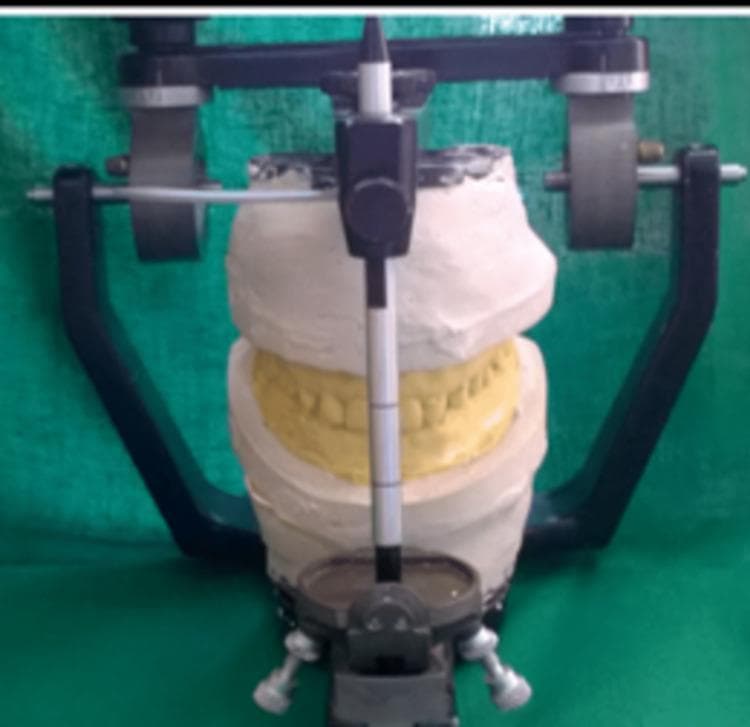 This procedural dental photograph shows a maxillary and mandibular diagnostic study model mounted on a semi-adjustable articulator. The device consists of a dark metallic frame with an incisal pin positioned vertically at the anterior, marked with graduated linear divisions to establish and maintain vertical dimension. The dental casts are made of white gypsum plaster, with the tooth regions highlighted in a contrasting yellow material, likely representing a wax-up or a specific dental stone for enhanced visualization of the occlusion. The maxillary cast is rigidly attached to the upper member of the articulator, while the mandibular cast is fixed to the lower member, replicating the patient's maxillomandibular relationship recorded via a facebow and interocclusal records. This setup is a critical step in prosthodontic treatment planning, allowing for the evaluation of occlusion, mock preparations, and the design of restorative interventions such as laminate veneers.