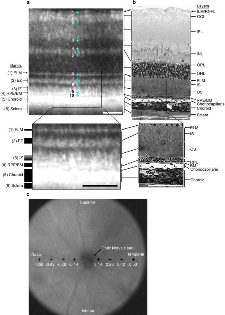 This medical educational composite illustrates the correlation between Spectral-Domain Optical Coherence Tomography (OCT) and light histology of the retina, specifically within a wild-type murine model.
Panel A presents a B-scan OCT image with numbered markers indicating retinal layers based on reflectivity: (1-2) hyperreflective ILM/RNFL and GCL; (2-3) moderately hyperreflective IPL; (3-4) hyporeflective INL; (4-5) hyperreflective OPL; and (5-6) hyporeflective ONL. The outer retina is further segmented into six bands: (1) External Limiting Membrane (ELM), (2) Ellipsoid Zone (EZ)/Inner Segments (IS), (3) Interdigitation Zone (IZ)/Outer Segments (OS), (4) Retinal Pigment Epithelium (RPE)/Bruch’s Membrane (BM) complex, (5) Choroid, and (6) Sclera.
Panel B shows the corresponding histological cross-section, with arrows and brackets aligning cellular structures to the OCT bands shown in Panel A. Panel C provides a fundus-view en face image showing the optic nerve head and the nasal/temporal eccentricities where measurements were taken. This comparison is essential for validating OCT-based diagnostic nomenclature and quantifying retinal layer thinning in ophthalmic research.