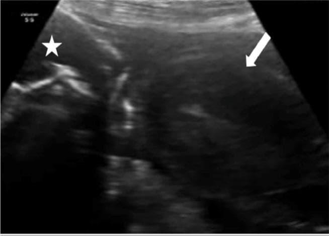 This diagnostic ultrasound image in the obstetric and gynecologic domain illustrates an abdominal pregnancy. The trans-abdominal scan reveals a fetus (marked with a white star) located outside the uterine cavity, positioned in close proximity to the maternal anterior abdominal wall. An empty, relatively amorphous uterus is identified separately (indicated by the white arrow). Key sonographic findings include the complete lack of myometrial tissue surrounding the fetus and the clear anatomical separation between the gestational sac and the uterine corpus. The fetus exhibits typical hyperechoic bony structures, while the adjacent uterine tissue presents a distinct, uniform echogenicity. This image serves as a clinical example of an extrauterine ectopic pregnancy, specifically an advanced abdominal pregnancy, emphasizing the diagnostic importance of identifying the relationship between the fetus and the empty uterus to prevent life-threatening maternal complications such as hemorrhage.