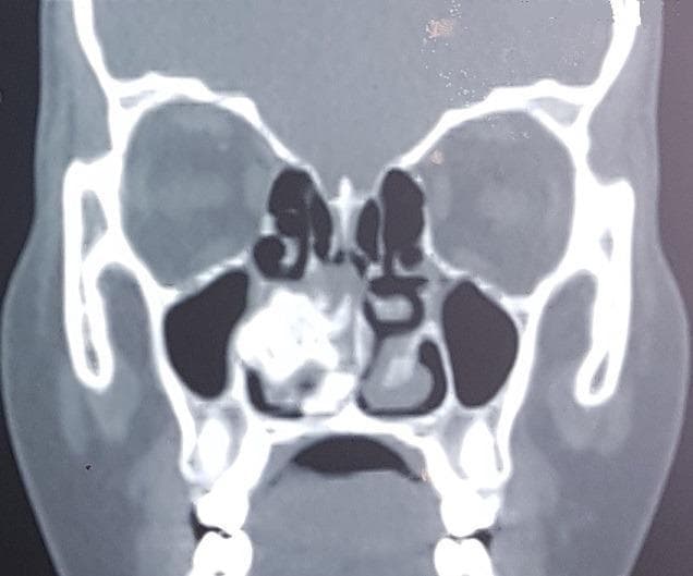 Hugging Face pmc clinical VQA raw