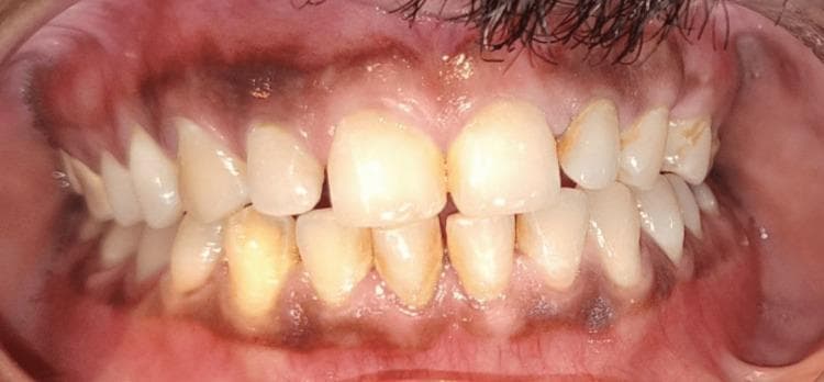 This clinical intraoral photograph displays a frontal view of the patient's dentition and gingiva six months following surgical treatment for a bilateral condyle and mandibular symphysis fracture. The image demonstrates a stable postoperative occlusion with a regular dental arrangement and a functional bite relationship between the maxillary and mandibular arches. The teeth exhibit generalized yellowish discoloration and staining, with visible dental plaque and calculus accumulated along the gingival margins. The gingiva shows signs of chronic inflammation, characterized by generalized erythema and localized recession that exposes the cervical regions of several teeth. Notably, physiologic melanin pigmentation (melanosis) is present as dark, patchy areas on both the attached and marginal gingiva. The lack of stippling and the rounded contour of the gingival margins suggest mild edema. This visual evidence highlights the successful restoration of occlusal stability following complex mandibular trauma and emphasizes the importance of postoperative periodontal maintenance.