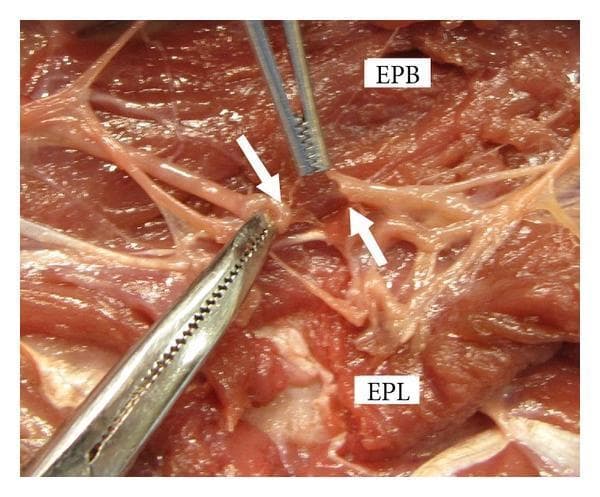 This clinical photograph displays a cadaveric gross dissection of the dorsal forearm, demonstrating a simulated Zone IX laceration injury. The image focuses on the deep muscle layer and neurovascular structures of the posterior compartment. Key anatomical landmarks identified by text labels include the Extensor Pollicis Brevis (EPB) and the Extensor Pollicis Longus (EPL). Two white arrows specifically indicate the severed ends of a motor branch of the posterior interosseous nerve (PIN) as it enters the EPL muscle. Surgical forceps are visible, retracting tissue to provide a clear view of the nerve gap and the surrounding damaged musculotendinous units. This visual emphasizes the clinical significance of identifying nerve involvement in dorsal forearm lacerations, particularly where distal extensor function (thumb and finger extension) is compromised despite intact superficial tendons.
