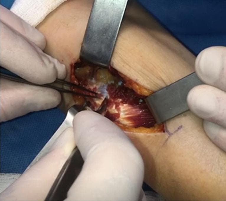 This clinical photograph captures an intraoperative view of the supinator muscle during an upper limb surgical procedure, likely a decompression of the posterior interosseous nerve (PIN). The surgical field shows a longitudinal incision distal to the lateral epicondyle of the forearm. Metallic retractors are placed at the proximal and distal margins to provide exposure, revealing the deep red, striated fibers of the supinator muscle running in an oblique orientation. The proximal portion of the muscle shows the initiation of blunt dissection, where the overlying fascia and yellowish subcutaneous adipose tissue are being separated from the muscle belly. A pair of surgical forceps is positioned to grasp and elevate the proximal tissue, while a scalpel is visible in the lower right, assisting in the dissection. The surgical field is moist and glistening, reflecting standard anatomical exposure within a controlled operative environment. This image serves as a teaching tool for identifying the supinator muscle and understanding the surgical approach for nerve decompression in the proximal forearm.