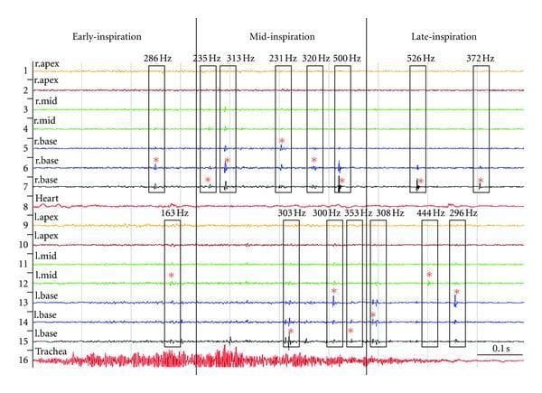 This diagnostic visualization is a multi-channel time-amplitude stack plot of inspiratory lung sounds from a patient with pneumonia, demonstrating multichannel lung sound analysis. The plot consists of 16 vertically arranged channels: channels 1–7 represent the right lung (apex, mid, and base), channels 9–15 represent the left lung (apex, mid, and base), with additional channels for the heart (8) and trachea (16). The horizontal axis denotes time, partitioned by thick vertical lines into early-inspiration, mid-inspiration, and late-inspiration phases. Adventitious lung sounds, specifically crackles, are visualized as discrete high-amplitude spikes. These are grouped into 'crackle families' indicated by black rectangular borders. Key diagnostic annotations include the crackle pitch frequency (Hz) labeled at the top of each border and a red star (*) identifying the 'mother crackle' (the primary or originating deflection). The data illustrates a clinical trend of increasing crackle frequency and density as inspiration progresses from the mid to late phases, particularly noticeable in the basal segments of both lungs.