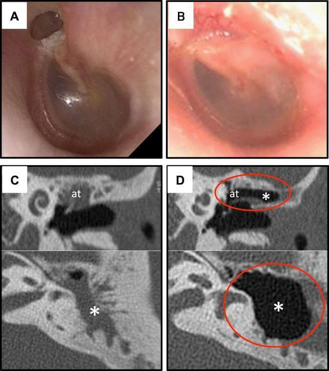 Educational comparison of preoperative and 12-month postoperative findings for pars flaccida cholesteatoma treated with cell sheet transplantation. (A) Otoscopic clinical photograph showing preoperative retraction of the attic and visible cholesteatoma. (B) Postoperative clinical photograph demonstrating a healthy tympanic membrane with no recurrence or retraction. (C) Preoperative computed tomography (CT) in coronal (top) and axial (bottom) views showing opacified attic (at) and mastoid cavity (*) with absent pneumatization due to disease. (D) 12-month postoperative CT scans highlighting successful restoration of air-filled spaces (black) in the attic and mastoid regions (circled in red), indicating effective mucosal regeneration and cavity ventilation. This composite image serves as a clinical case study in otolaryngology for regenerative surgical techniques in middle ear disease.