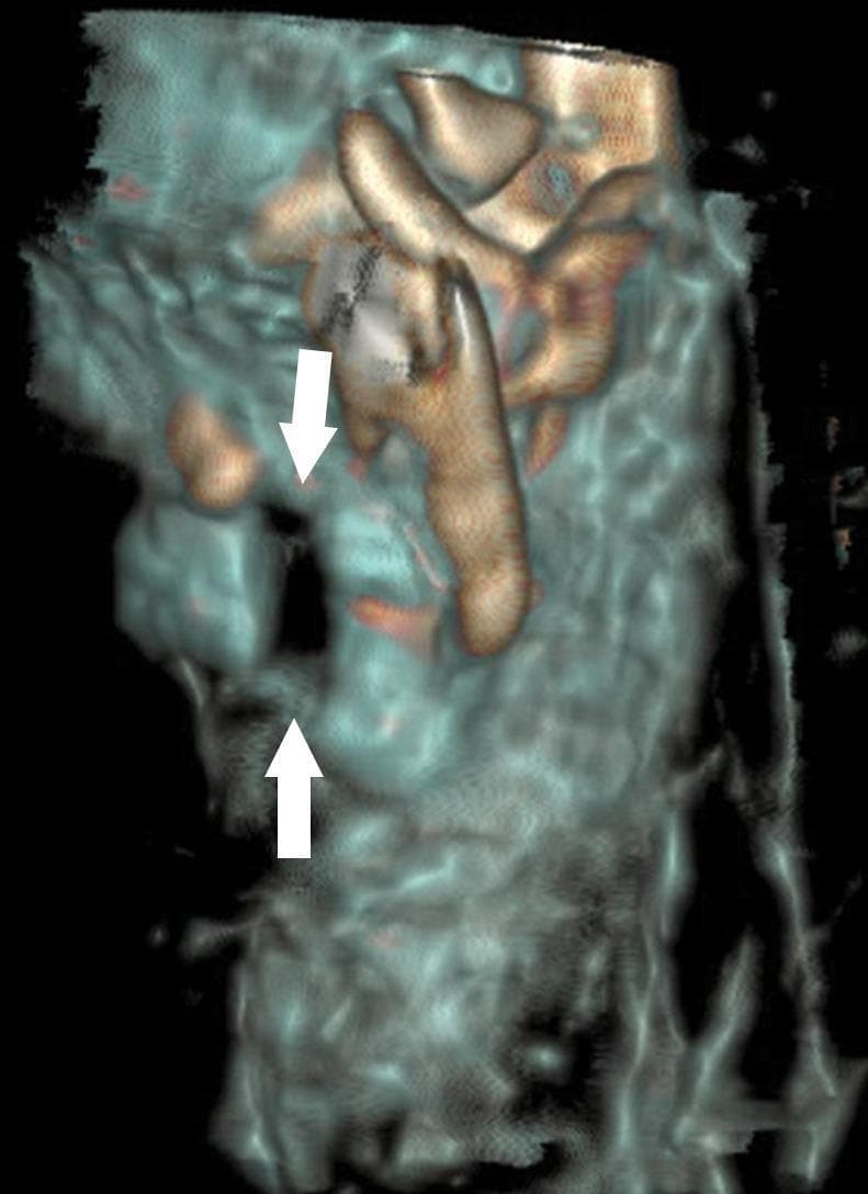 This diagnostic image is a three-dimensional (3D) volume-rendered reconstruction from a postmortem CT scan of the cervical region. The visualization focuses on the laryngeal skeleton, specifically the cricoid cartilage and its surrounding structures. High-density osseous and calcified cartilaginous tissues are rendered in tan/gold tones, while lower-density soft tissues appear in translucent blue-grey. Two white arrows indicate a clear, displaced bilateral fracture of the cricoid cartilage, characterized by a visible gap and loss of anatomical continuity in the ring-like structure. The reconstruction demonstrates the clinical utility of postmortem imaging in forensic pathology for identifying deep neck injuries, such as those resulting from blunt force or manual strangulation, which may be difficult to isolate during physical autopsy without causing iatrogenic manipulation. This material is suitable for advanced educational use in forensic radiology, trauma imaging, and laryngeal anatomy.
