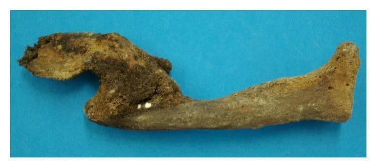 This clinical photograph displays a dry bone specimen of a human clavicle exhibiting an old, healed fracture with significant malunion. The primary pathology is a midshaft clavicular fracture where the dislocated bone ends have fused in an overlapped, non-anatomical position. This remodeling has resulted in a permanent shortening and angular deformity of the bone compared to normal S-shaped clavicular anatomy. A prominent bony callus and irregular overgrowth are visible at the site of fusion, indicating extensive new bone formation and bridging during the healing process. The specimen shows varying degrees of mineralization and taphonomic discoloration, with darker brown areas concentrated around the fracture site and lighter, porous tan areas across the cortical surface. This image serves as a paleopathological example of traumatic bone injury and subsequent biological repair without clinical intervention, illustrating the processes of bone remodeling and fusion after severe displacement.