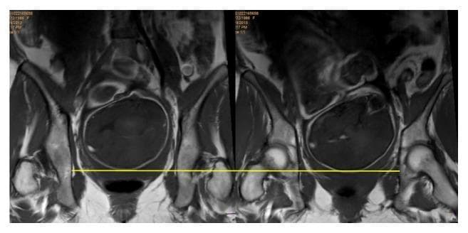 This diagnostic image consists of two side-by-side MRI scans in the coronal plane, focused on the maternal pelvis during late-term pregnancy. The images demonstrate the fetal head engaged within the pelvic canal. Key maternal anatomical landmarks include the iliac wings, the acetabula, and the ischial spines. A horizontal yellow reference line is drawn across the interspinal plane, connecting the maternal ischial spines. This line serves as a clinical marker for determining fetal station. The fetal skull is seen as a well-defined, dark, ovoid structure, with its leading part positioned at the level of the yellow interspinal line, visually confirming a fetal station of 0. This imaging is utilized in obstetrics to objectively assess the progress of fetal descent and engagement within the birth canal, comparing clinical examination findings with high-resolution radiological evidence.