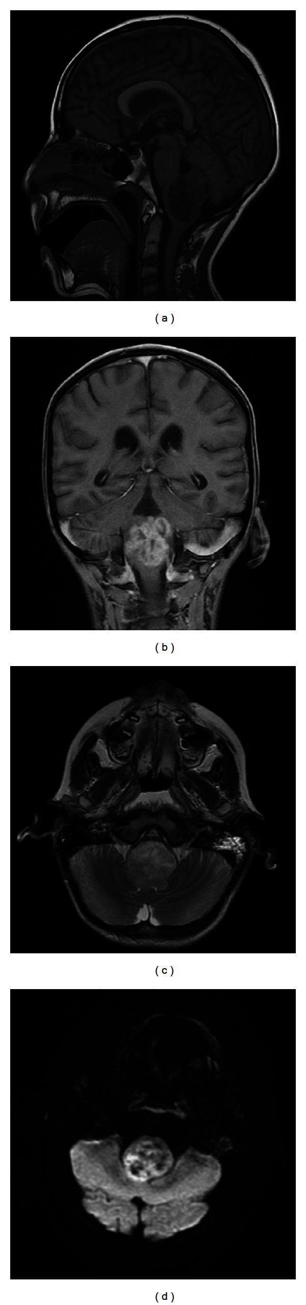 A multi-paneled diagnostic MRI series illustrating the neuroradiological features of an Atypical Teratoid Rhabdoid Tumor (ATRT) in the posterior fossa. Panel (a) is a sagittal T1-weighted image showing a large, heterogeneous, exophytic mass centered in the medulla and lower brainstem with dorsal extension into the fourth ventricle. Panel (b) shows a postcontrast coronal T1-weighted image demonstrating robust, heterogeneous contrast enhancement of the mass. Panel (c) is a transaxial T2-weighted sequence highlighting significant compression of the ventral medulla and displacement of adjacent structures. Panel (d) displays a transaxial diffusion-weighted imaging (DWI) sequence where the tumor exhibits hyperintense signal, indicating restricted diffusion, which is a characteristic feature of highly cellular tumors like ATRT. The imaging demonstrates typical pediatric neuro-oncological findings including mass effect on the brainstem and lack of prominent surrounding vasogenic edema. This sequence is representative of diagnostic workups for pediatric brainstem tumors and emphasizes the role of multi-planar, multi-sequence MRI in characterizing tumor morphology and cellularity.