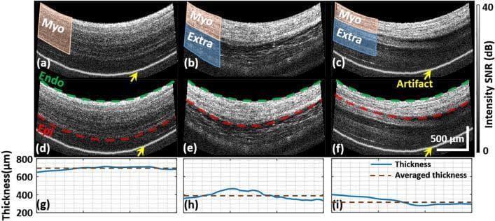 Educational figure illustrating the segmentation and thickness measurement of the myocardial wall using Polarized Sensitive Optical Coherence Tomography (PSOCT). Panels (a-c) present grayscale structural cross-sectional images of the cardiac wall. The myocardium (Myo) is highlighted in orange, while extra-myocardial tissues (Extra), such as adipose or pericardium, are highlighted in blue. Panels (d-f) demonstrate the corresponding automated or manual segmentation of the wall layers, with dashed green lines identifying the endocardium (Endo) and dashed red lines identifying the epicardium (Epi). A scale bar indicates 500 µm. Yellow arrows point to imaging artifacts originating from the probe. Panels (g-i) provide quantitative line graphs showing the calculated wall thickness in microns (µm). The solid blue line tracks real-time thickness variations across the scanned area, while the dashed brown line indicates the mean averaged thickness. This figure serves to teach the methodology for distinguishing myocardial boundaries from adjacent anatomical structures to ensure accurate clinical measurement of cardiac wall dimensions.