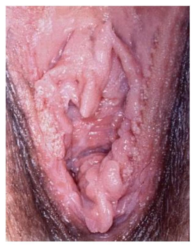 Clinical photograph of the female external genitalia showing extensive human papillomavirus (HPV) infection presenting as condyloma acuminata (genital warts). The lesions are characterized by multiple raised, exophytic, and papillary growths with a verrucous (cauliflower-like) texture. The distribution is widespread across the vulvar area, involving the labia minora, labia majora, and the vaginal introitus. Morphologically, the lesions appear flesh-colored to pale pink, with some areas exhibiting a whitish, hyperkeratotic surface. There is evidence of epithelial thickening and irregular surface contours, deviating from normal smooth mucosal architecture. This image illustrates the typical clinical presentation of low-risk HPV-induced benign neoplasia, which is a key diagnostic feature in gynecology and dermatology for distinguishing between infectious viral warts and other vulvar intraepithelial neoplasia (VIN) or malignant conditions.
