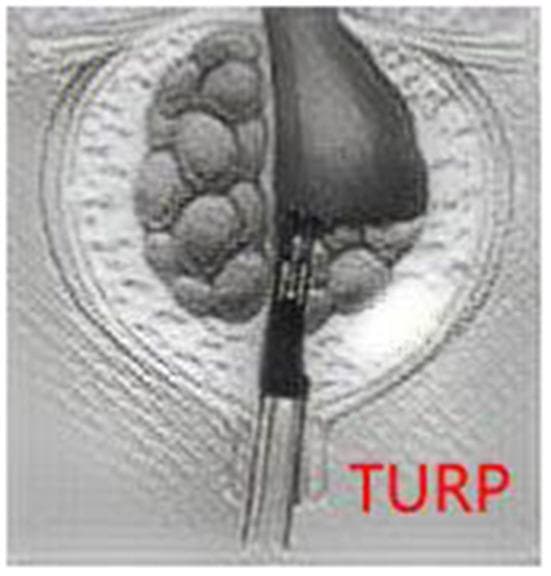 A medical illustration depicting the Transurethral Resection of the Prostate (TURP) procedure. The image shows a transverse or cross-sectional view of the prostate gland housed within its surgical capsule. The left side of the gland exhibits a nodular, bumpy texture characteristic of benign prostatic hyperplasia (BPH) with multiple distinct lobules. A metallic, cylindrical surgical instrument—a resectoscope—is positioned centrally within the prostatic urethra. The resectoscope is actively removing tissue from the right side of the gland, creating a smooth, hollowed-out surgical bed as it resects tissue from the bladder neck toward the verumontanum. The anatomical focus is the lower urinary tract, specifically the prostate gland's internal architecture during a minimally invasive urological intervention. This diagram serves as a clinical education tool to demonstrate the mechanical removal of obstructive prostatic tissue to alleviate urinary symptoms.