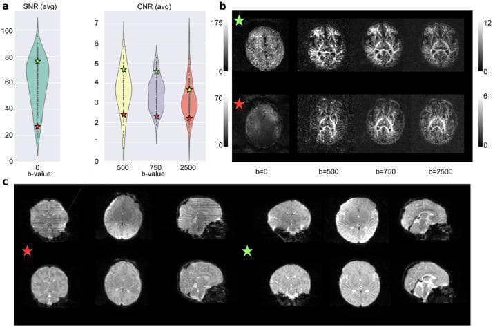 This three-panel figure illustrates quality control (QC) metrics for neonatal diffusion MRI (dMRI) data processing. Panel (a) features violin plots displaying the distribution of average Signal-to-Noise Ratio (SNR) at b=0 and Contrast-to-Noise Ratio (CNR) at b-values of 500, 750, and 2500 s/mm² for the study population. Two representative subjects are highlighted: a high-quality outlier (green star) and a low-quality outlier (red star). Panel (b) presents the corresponding axial SNR and CNR maps for these two subjects, demonstrating superior signal intensity and structural definition in the high-SNR subject across all b-values, while the low-SNR subject exhibits significant noise and reduced contrast. Panel (c) compares b0 intensity images for both subjects before (top row) and after (bottom row) a processing pipeline. The comparison highlights the pipeline's efficacy in correcting Echo Planar Imaging (EPI) geometric distortions and magnetic field inhomogeneities. For the red-star subject, the post-processing images show marked reduction in signal dropout and improved anatomical alignment, illustrating the importance of rigorous QC in neonatal neuroimaging research.