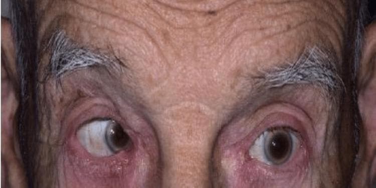 This clinical photograph displays a close-up frontal view of an elderly patient's eyes and forehead, illustrating a left-sided cranial nerve VI (abducens nerve) palsy. The right eye appears centrally fixed, while the left eye shows a marked medial deviation (esotropia) with an inability to abduct. This visual finding is consistent with left lateral rectus muscle paralysis. The patient's forehead exhibits prominent horizontal rhytids (wrinkles) and graying eyebrows, consistent with the reported age of 86. The skin of the periocular region shows no acute inflammatory changes, rashes, or bruising. The educational focus of this image is the clinical presentation of an isolated abducens nerve palsy, which in this case was secondary to pituitary apoplexy with mass effect. It serves as a diagnostic example for neurology and ophthalmology training regarding extraocular movement deficits and conjugate gaze impairment.