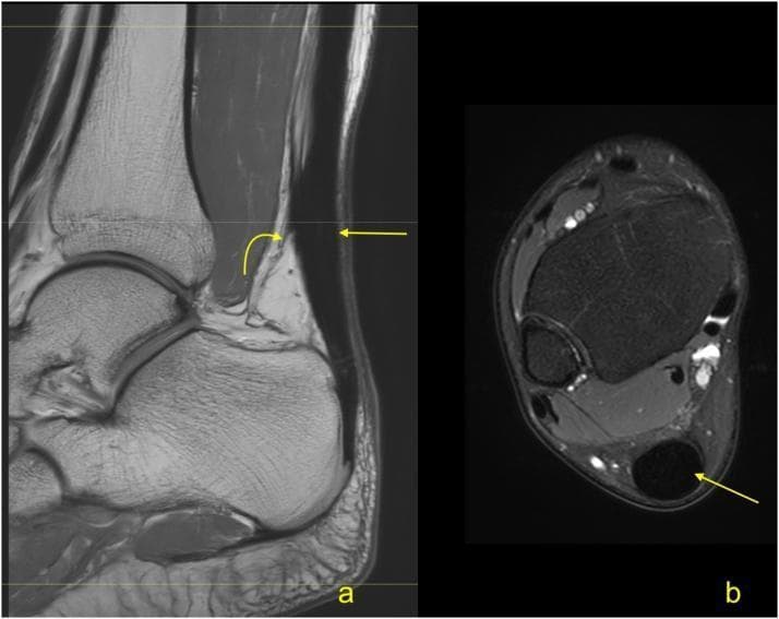 This diagnostic imaging set consists of two MRI views of the ankle and Achilles tendon in a 63-year-old patient following a partial rupture eight months prior. Image 'a' is a sagittal PD-weighted (proton density) MRI showing the Achilles tendon and Kager's fat pad. A straight yellow arrow indicates the area of tendon remodeling, characterized by persistent thickening and altered signal intensity despite clinical recovery. A curved yellow arrow points to peritendinous adhesions within Kager's fat pad, visible as linear low-signal bands. Image 'b' is an axial PD-weighted MRI with fat suppression. The straight yellow arrow highlights the thickened, hypointense Achilles tendon in cross-section. The use of fat suppression in this view increases the conspicuity of possible edema or fluid within the paratenon and adjacent soft tissues. These images illustrate the typical long-term morphological changes and postoperative sequelae, such as fibrosis and adhesions, following traumatic Achilles injury.