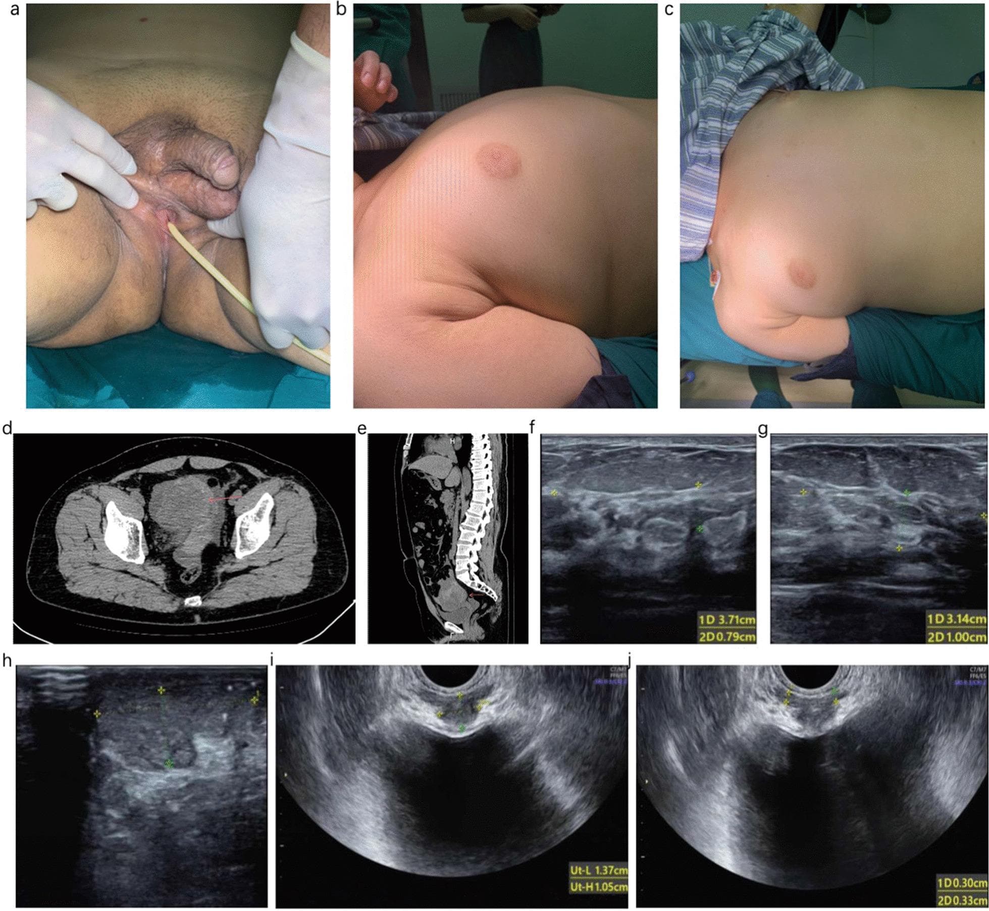 This composite figure presents clinical and diagnostic imaging from a case of 46XY Disorder of Sexual Development (DSD). (a) Clinical photograph of ambiguous external genitalia showing a normal-sized phallus positioned superiorly and a female-like urethral opening in the perineum with an inserted catheter. (b, c) Clinical photographs of the torso demonstrating bilateral Grade II gynecomastia. (d) Axial and (e) sagittal CT scans of the pelvis identifying a solid tumor mass (red arrows) located posterior to the bladder and anterior to the rectum. (f, g) Ultrasound images of the mammary glands showing fibroglandular tissue measurements. (h) Ultrasound of the left scrotal testicle. (i, j) Transrectal or pelvic ultrasound images revealing internal structures including a prostate-like echo and bilateral seminal vesicles. The collection illustrates the phenotypic and internal anatomical hallmarks used in the differential diagnosis of DSD, specifically partial gonad dysgenesis associated with a pelvic seminoma mixed with yolk sac tumor.