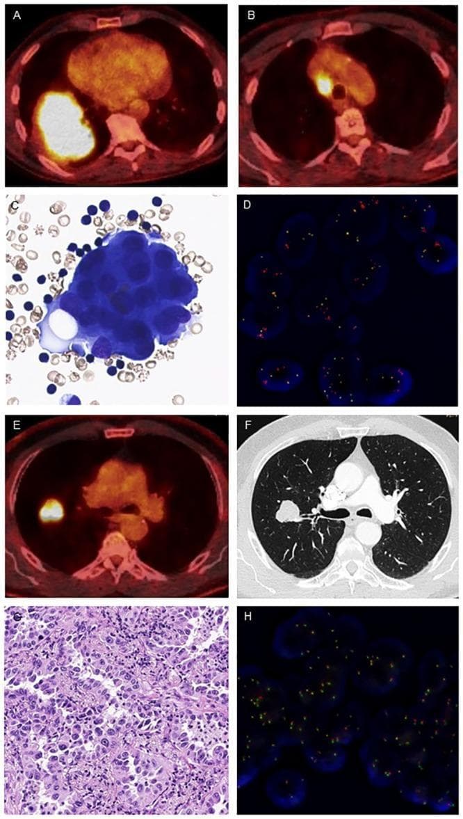 This composite figure presents clinical imaging and microscopy findings comparing ALK-rearranged (A-D) and ALK wildtype (E-H) lung adenocarcinoma. (A-B) Axial PET-CT fusion images show a large, hypermetabolic mass in the right lower lobe with associated FDG-avid ipsilateral mediastinal lymphadenopathy, characteristic of metastatic ALK-rearranged lung cancer. (C) Cytological preparation (May-Grünwald stain, 400x) displays clusters of atypical adenocarcinoma cells with high nuclear-to-cytoplasmic ratios. (D) ALK fluorescence in situ hybridization (FISH) demonstrates positivity via split red and green signals, indicating gene rearrangement. (E-F) Axial PET-CT and CT images of an ALK wildtype patient reveal a solitary hypermetabolic pulmonary nodule in the right upper lobe without mediastinal involvement. (G) Histopathological section (H&E stain, 200x) shows adenocarcinoma cells arranged in solid and glandular patterns. (H) ALK FISH negativity is indicated by predominantly fused (yellow) signals, representing an intact ALK gene. The collection highlights the correlation between molecular subtypes, radiographic presentation (centrality/lymphadenopathy), and diagnostic cytopathology/FISH testing.