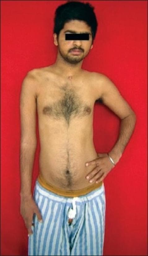 Clinical photograph of a young male patient demonstrating the characteristic physical presentation of a right-sided upper brachial plexus palsy (C5, C6, C7), likely following microneuroreconstruction. The image shows significant upper limb asymmetry: the right shoulder is depressed (slumped) compared to the left. The right arm exhibits postural abnormalities including internal rotation at the shoulder, adduction, and extension at the elbow, often referred to as a 'waiter's tip' position or Erb's palsy-like presentation. Muscle atrophy is visible in the right deltoid and pectoral regions. A small, well-healed, linear surgical scar (approximately 2 cm) is located in the midline suprasternal/cervical region, consistent with prior nerve reconstruction surgery or access to the brachial plexus. In contrast, the left upper limb shows normal muscle bulk and posture, with the hand resting on the hip. This visual aid is primarily used for teaching clinical signs of peripheral nerve injury and the outcomes of surgical nerve repair in neurology and orthopedics.