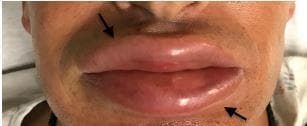 This clinical photograph displays a close-up view of the lower face of an adult patient exhibiting severe, isolated angioedema. The primary finding is significant bilateral edema of both the upper and lower lips, which appear markedly enlarged and erythematous. The arrows in the image highlight the boundaries of the swelling at the vermilion border. The lip surface appears taut and smooth, consistent with acute interstitial fluid accumulation. Notably, the surrounding perioral skin, chin, and nose show no signs of similar swelling or inflammation, indicating the localized nature of the reaction. This visual serves as a classic representation of acute angioedema, a condition often associated with allergic reactions, ACE-inhibitor use, or environmental exposures such as Karenia brevis (red tide) as indicated in the clinical context. The image is intended for medical education in dermatology and emergency medicine to teach the identification of localized soft tissue edema without systemic cutaneous involvement.