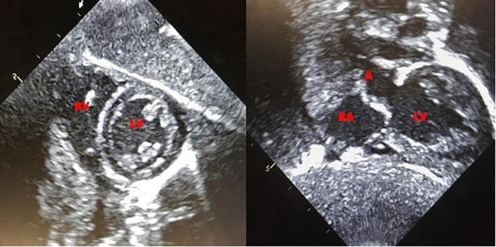 This diagnostic imaging contains two side-by-side echocardiogram frames from a patient at 11 weeks of life, demonstrating the resolution of previously noted biventricular hypertrophy. The left panel shows a short-axis view of the heart, where the left ventricle (LV) and right ventricle (RV) are labeled. The ventricular septal wall and free walls appear to have normalized in thickness, and the LV chamber maintains a regular circular morphology. The right panel displays a different echocardiographic plane, likely an apical or subcostal view, labeling the right atrium (RA), the aorta (A), and the left ventricle (LV). The image highlights the normal proportional relationship between the cardiac chambers and the outflow tract. This visual documentation is clinically significant for monitoring the progression and treatment response of pediatric cardiomyopathies, such as those associated with Pompe disease or other metabolic disorders. The educational focus is on identifying cardiac anatomy and assessing ventricular wall thickness using neonatal ultrasound.