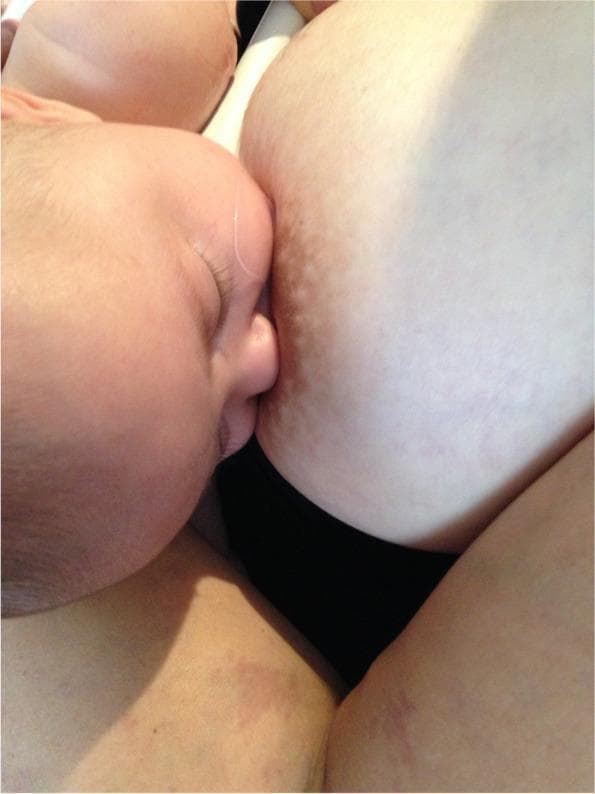 A clinical photograph depicting an infant latched onto a mother's breast, illustrating a post-gestalt intervention breastfeeding position. The image provides a lateral view of the infant's face in close proximity to the breast tissue. The infant's mouth is wide open and fully sealed around the nipple and a significant portion of the lower areola, demonstrating an asymmetrical, deep latch. The infant's nose is positioned lightly against the breast, and the chin is tucked firmly into the breast tissue. The cheeks appear rounded without visible dimpling, suggesting effective intra-oral vacuum and stability. The areola shows slight stretching and distortion consistent with active breastfeeding. This visual serves as an educational example of optimal breastfeeding mechanics and positioning designed to maximize milk transfer and minimize maternal nipple pain by increasing intra-oral breast tissue volume.
